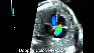 Insuficiencia tricuspidea Doppler Color Manipulando el PRF [upl. by Illom117]