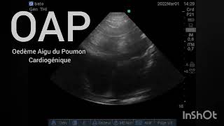 OAP Oedème Aigu du Poumon sur Insuffisance cardiaque gauche chronique Échographie Urgences [upl. by Oiciruam]