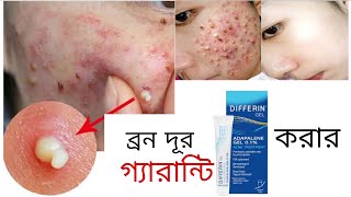 রাতে এই জেল লাগান সকালে ব্রন গায়েব হয়ে যাবে Differin Adapalene Gel  khadija begum  acne treatment [upl. by Assyle]