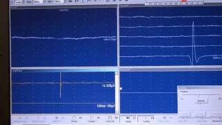 EMG JVC Fasciculaciones [upl. by Enileuqkcaj277]