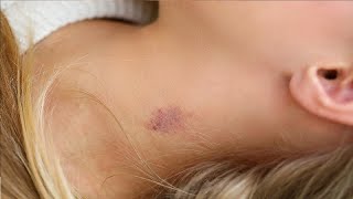 easiest way to give a hickey in 3 minutes [upl. by Raddie]