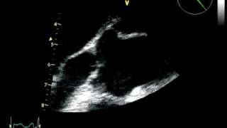 BIG AORTIC VEGETATION  INFECTIVE ENDOCARDITIS ECHOCARDIOGRAPHY cardiac ultrasound [upl. by Laenej]