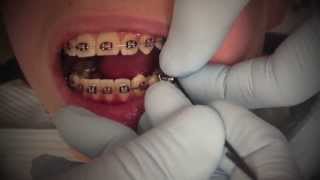 Herbst Appliance for correction of class II correction with braces 2013 [upl. by Atsyrc]