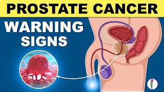 Prostate Cancer Signs  Warning Signs of Prostate Cancer [upl. by Stoll]