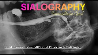 SIALOGRAPHY of submandibular gland [upl. by Imoin10]