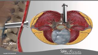 Lumbar Microdiscectomy  Spine Center Northern Nevada Northern California  Spine Surgery [upl. by Sonafets]