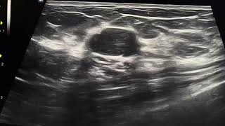 Breast Mass Fibroadenoma ultrasound biopsy proven  ARDMS sonography radiology [upl. by Llecrad]