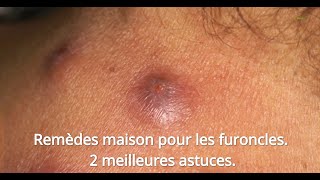 Remèdes Maison Pour Les Furoncles 2 Meilleures Astuces [upl. by Keefe943]