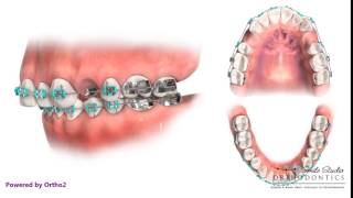 Orthodontic Treatment for Overjet Overbite  Extraction of First Upper Premolars [upl. by Tandie935]