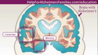 Alzheimers Effect on the Brain [upl. by Yasui]