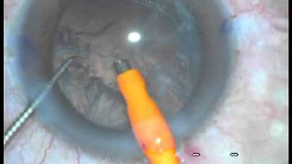 Cataract Surgery at JP Eye Hospital Mohali chandigarh By DrJatinder Singh [upl. by Aidul]