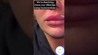 Dissolving Migrated Lip Filler [upl. by Tarrah829]