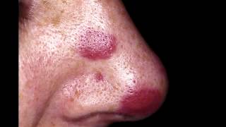 Kaposis Sarcoma  Usually in AIDS patients with HHV8 [upl. by Shermie]