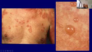 Spongiotic amp Psoriasiform Dermatoses [upl. by Idnahs697]