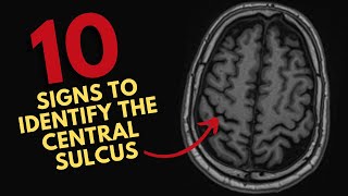 How to find the central sulcus on MRI [upl. by Eelrihs]