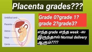 placenta grades 0grade 1grade 2grade 3 [upl. by Hairacaz]