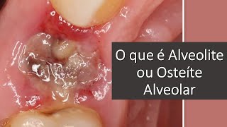 O que é Alveolite ou Osteíte Alveolar  Odontologia  Dra Bianca Rosa [upl. by Cogn]