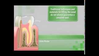 GuttaFlow2 D Root Canal Filling System [upl. by Selyn539]