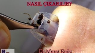 Silikon Burun Tamponu Nasıl Çıkarılır Nasal Splint Removal [upl. by Burnside]