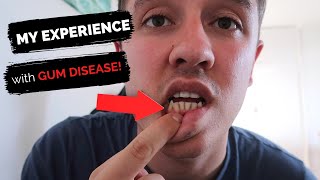 MY EXPERIENCE WITH GUM DISEASE [upl. by Nidia]