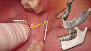 ALVEOLAR INFERIOR NERVE BLOCK  The Best Straightforward Explanation Ever [upl. by Imoian]