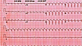 Ventricular Arrythmias and Sudden Cardiac Death  Presentation [upl. by Anotyal182]