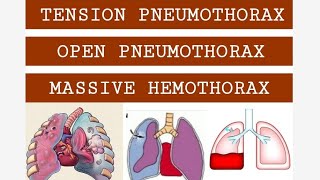 TENSION PNEUMOTHORAX OPEN PNEUMOTHORAX amp MASSIVE HEMOTHORAX [upl. by Meerek]