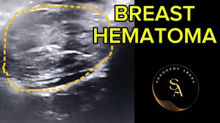 BREAST HEMATOMA Ultrasound case [upl. by Zohar158]