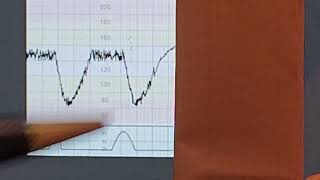 CTG interpretation  Cardiotocography  Dr Abdulrahim Gari [upl. by Attelra]