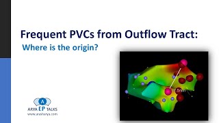 Frequent PVCs from Outflow Tract Where is the Origin [upl. by Riki]