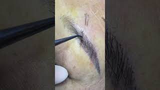 Eyebrow and Hair Transplanteyebrow eyebrowtransplantation eyelashextensions eyebrows eyebrow [upl. by Nyraa]