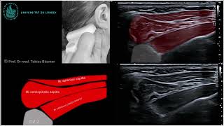 Sonographische Darstellung der kurzen Nackenmuskeln [upl. by Docilla]