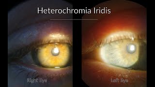 Fuchs Heterochromic Iridocyclitis  Ophthalmology cases [upl. by Bywaters]