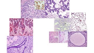 Lung adenocarcinoma histology [upl. by Dnob]