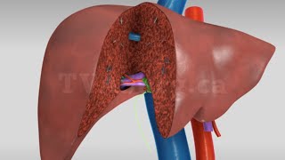 Liver transplant Living donor right hepatectomy donor procedure [upl. by Andie]