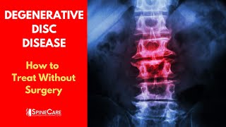 What is DEGENERATIVE DISC DISEASE  How to Treat It WITHOUT SURGERY [upl. by Haran581]