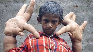 Meet The Boy With The World’s Largest Hands [upl. by Nolita]