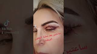 تجربتي مع عملية الجفن المبطن  Blépharoplastie👍🥰🥰 [upl. by Assitruc518]