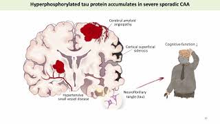 Cerebral Tau Pathology in Cerebral Amyloid Angiopathy [upl. by Okiek364]