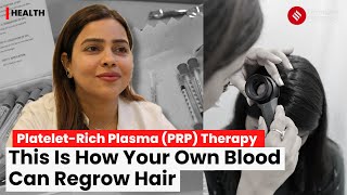 PRP Hair Treatment How This Therapy Helps Hair Growth With Your Own Blood  PRP Therapy Explained [upl. by Scholem]