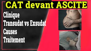 Ascite Conduite a Tenir Causes Traitement  Gastrologie Medicale [upl. by Aidan]