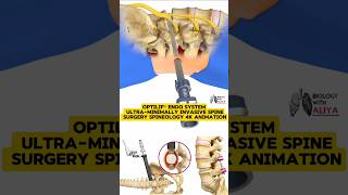 OptiLIF® Endo System  UltraMinimally Invasive Spine Surgery  Spineology  4K Animation 3d short [upl. by Ottinger]