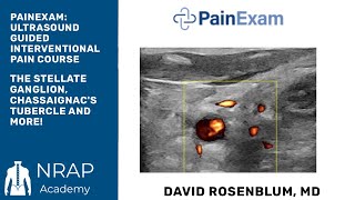 Ultrasound Guided Stellate Ganglion Chassaignacs Tubercle amp Interscalene Brachial Plexus [upl. by Annoerb]