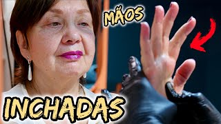 Mão Inchada e Doloridas O Que Pode Ser  5 Remédios Caseiros Para Mãos Inchadas [upl. by Ilyse]