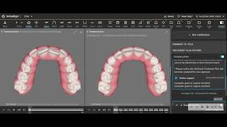 Great Result With Invisalign First for Early Interceptive Treatment [upl. by Steven]