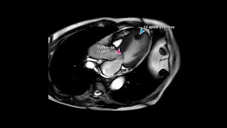 StressInduced Takotsubu Cardiomyopathy [upl. by Islehc]