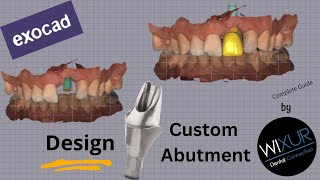 Design A Custom Abutment Maxillary Anterior [upl. by Amary236]