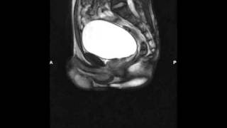 12 Shy Bladder  Paruresis Breath holding in an MRI [upl. by Erving]