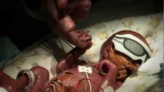 24 week premature baby  Tobys journey [upl. by Oznole773]