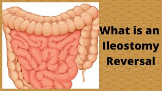 What is an Ileostomy Reversal [upl. by Notxap320]